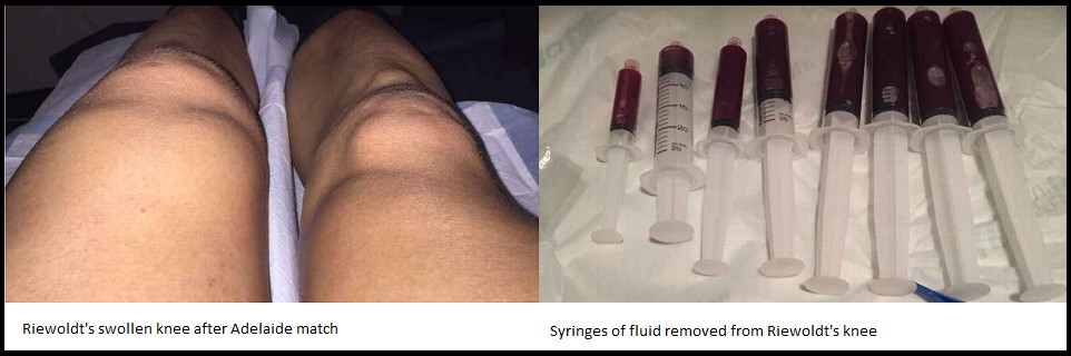 thumbnail_Swollen Knee and Fluid